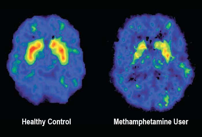 Zwei MRI-Gehirn-Scans nebeneinander, einer mit der Bezeichnung "gesunder Kontroll" und der andere mit der Bezeichnung "Methamphetamin-Nutzer", mit dem Text "Methamphetamin-Nutzer vs. gesunder Kontroll" unten.